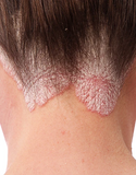 Dermabon Psoriasis Control Treatment (Single Bar 2.4oz)